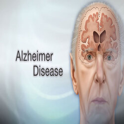 Alzheimer's Disease